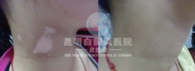白癜风怎样自我诊断
