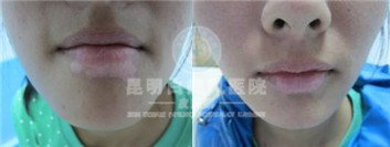 面部白癜风的危害严重吗?