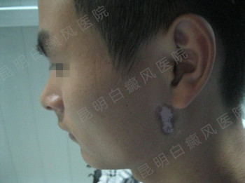 男性耳部局限型白癜风2年