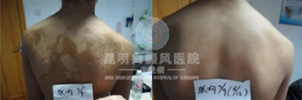 背部白癜风的危害你了解多少
