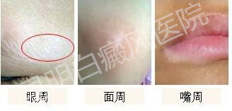 白癜风为何久治不愈?昆明白癜风医院带您避开就诊误区