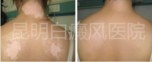 如何预防散发型白癜风呢?