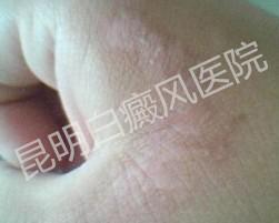 白癜风传染吗?