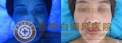 轻松告别白斑 还我丽人容颜